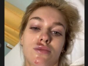 Tom Brady's rumored girlfriend Veronika Rajek gets badly injured on her Italy trip as she shares SHOCKING pictures of her bruised face from hospital